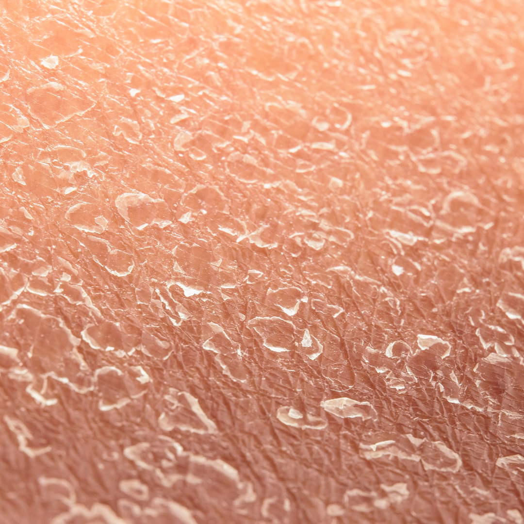 Ξηρή Επιδερμίδα