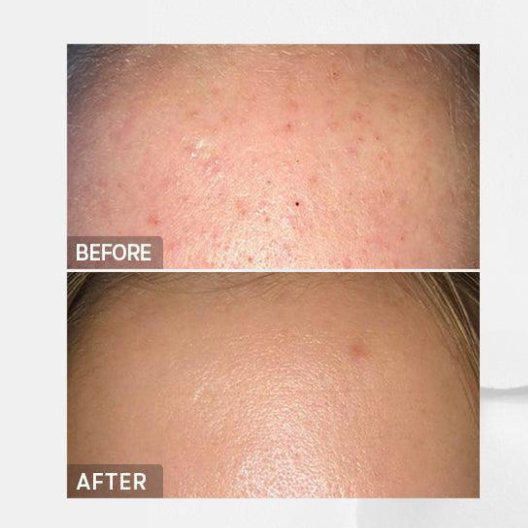 BHA Blackhead Power Liquid 100 ml